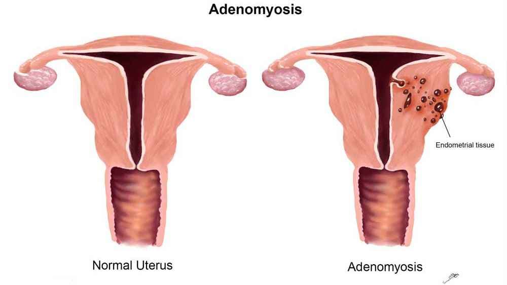 Comparison of a normal Uterus versus a Uterus with Adenomyosis 